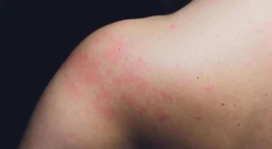 Vücutta Kaşıntısız Kızarıklık Nedenleri ve Doğru Cilt Bakımı Yöntemleri