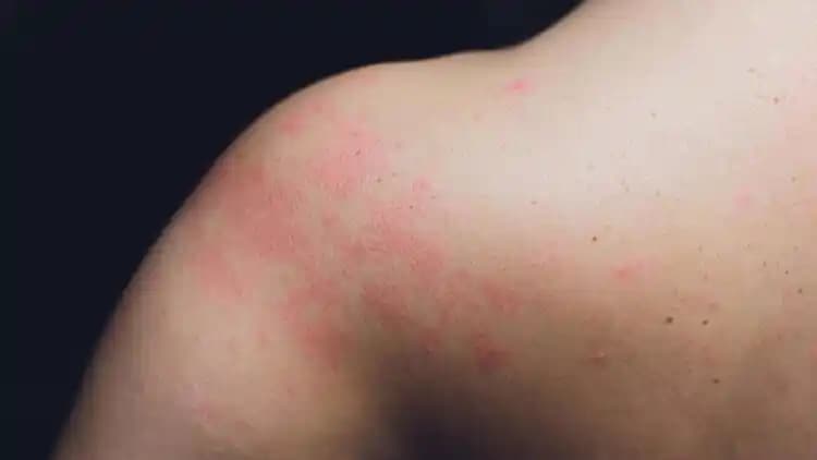 Vücutta Kızarıklık ve Kozmetik Yaklaşımlar: Nedenleri, Çözümleri ve Doğal Tavsiyeler