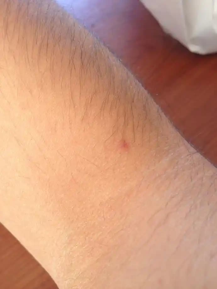 Vücutta Lekelerin Nedenleri, Çeşitleri ve Etkili Çözüm Yolları