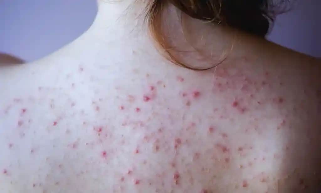 Vücutta Nokta Nokta Kabarmaların Nedenleri ve Çözüm Yolları Hakkında Detaylı Bilgi