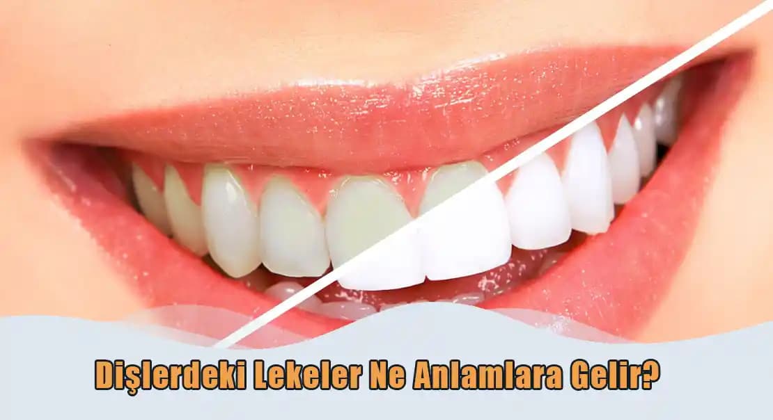 Vücutta Sarı Lekeler Ne Anlama Gelir? Cilt Renk Değişiklikleri ve Sağlık İpuçları