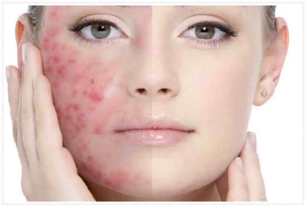 Vücutta Sivilce Çıkmasının Nedenleri ve Kozmetik Yaklaşımlar