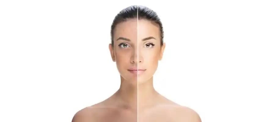 Vücutta Sivilceler Nasıl Giderilir: Etkili Yöntemler ve Doğal Çözümler