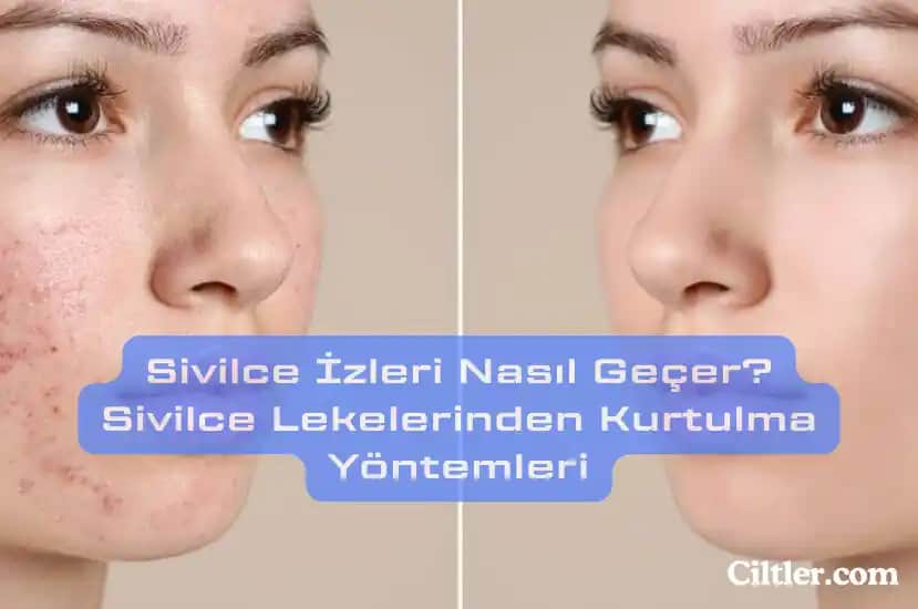 Yağlı Ciltlerde Sivilce İzlerini Azaltmak İçin Etkili Bakım Yöntemleri ve Doğal Çözümler