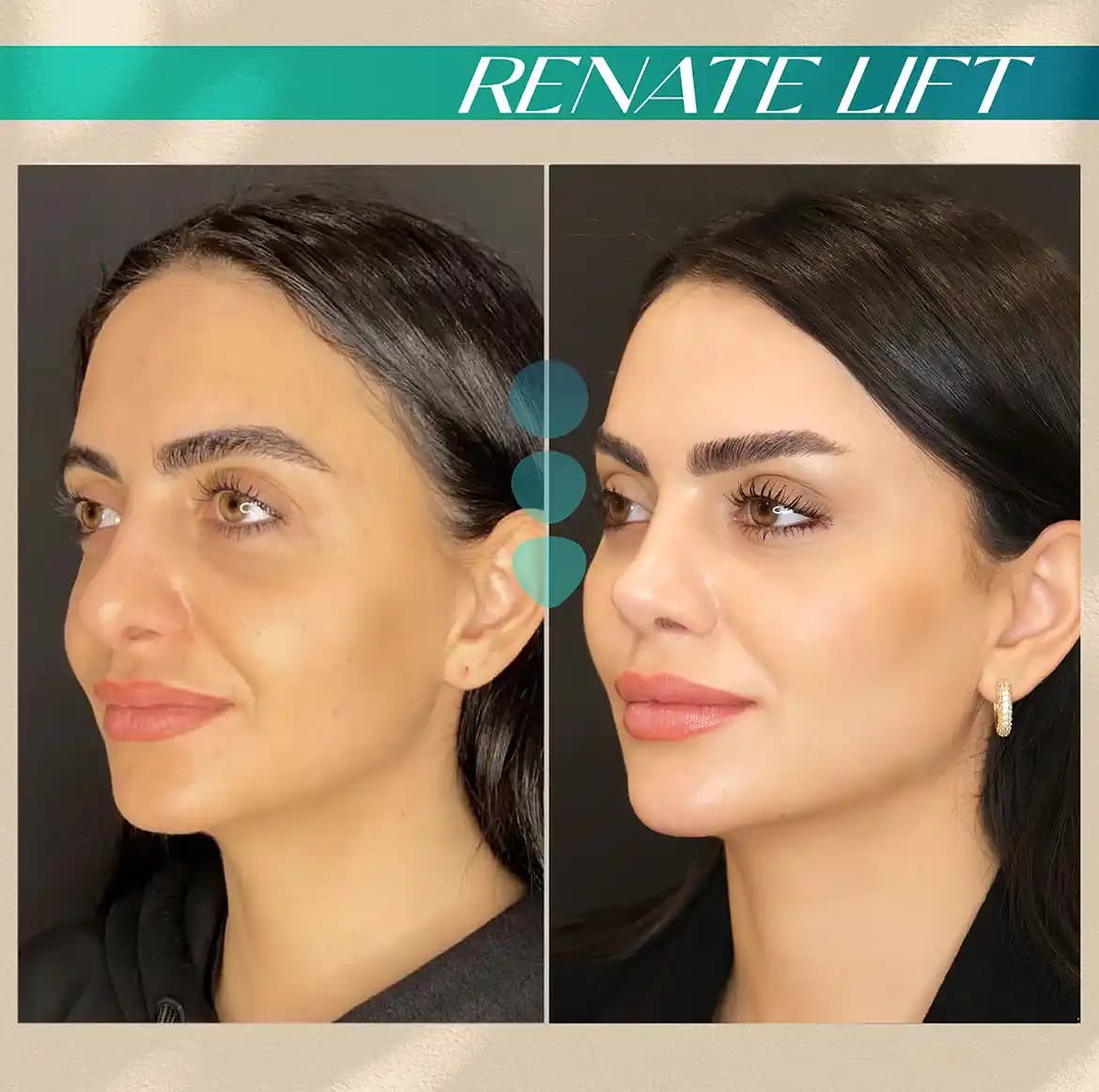 Yanak Dolgunlaştırma Yöntemleri ve Doğal Sonuçlar İçin Uzman Tavsiyeleri