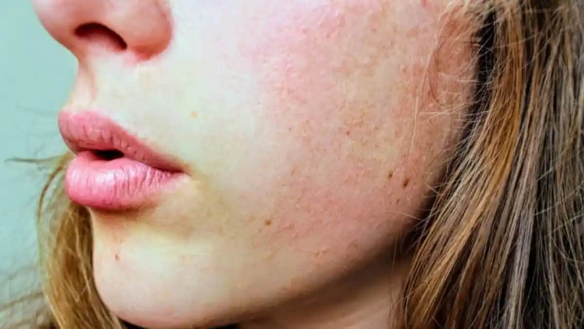 Yanaklarda Egzama Nedenleri, Belirtileri ve Doğru Bakım Yöntemleri