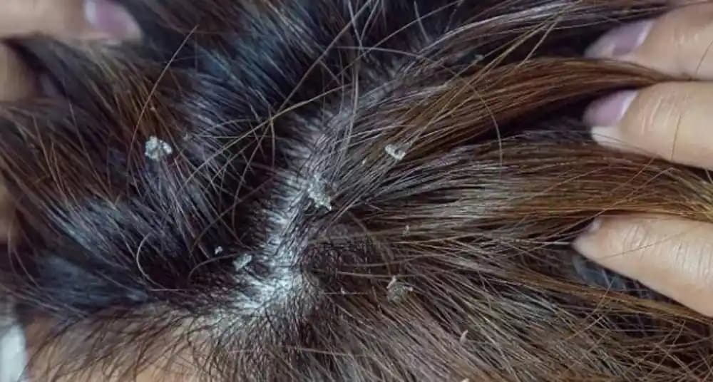 Yara Kabuklarının Doğal Geçiş Süreci ve Sağlıklı İyileşme Yöntemleri