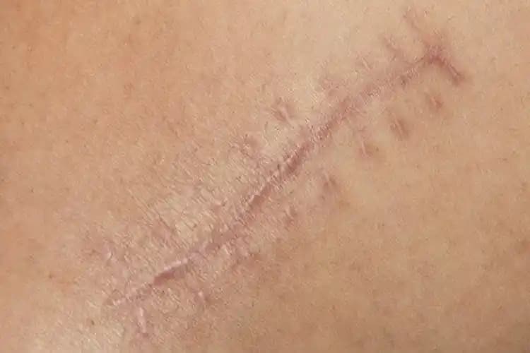 Yara Lekelerine Karşı Etkili Yöntemler ve Cilt Bakımında Dikkat Edilmesi Gerekenler