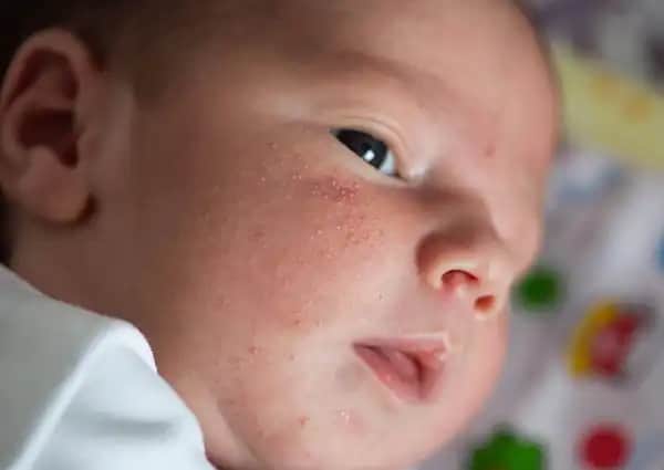 Yenidoğan Sivilcelerinin Nedenleri, Belirtileri ve Doğru Bakım Yöntemleri