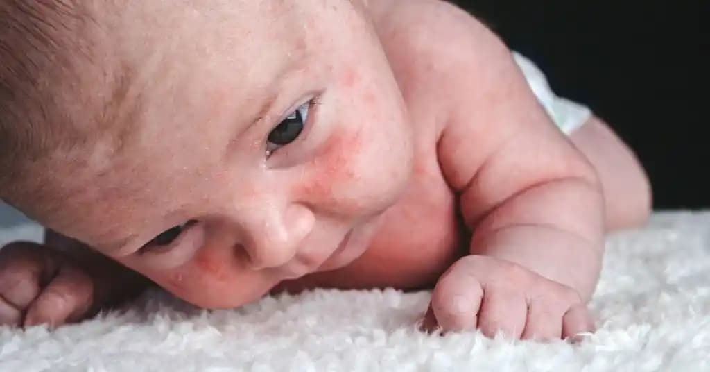 Yenidoğanın Yüzündeki Beyaz Noktalar: Nedenleri ve Bakım Önerileri
