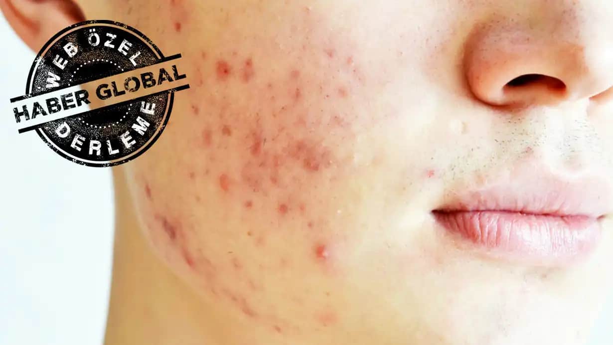 Yetişkin Sivilcesi Nedenleri ve Doğru Cilt Bakımı Yöntemleri