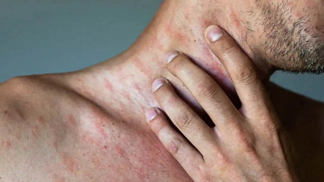 Yetişkinlerde Konak Sorunu ve Çözüm Yolları Cilt Sağlığını Koruma Rehberi