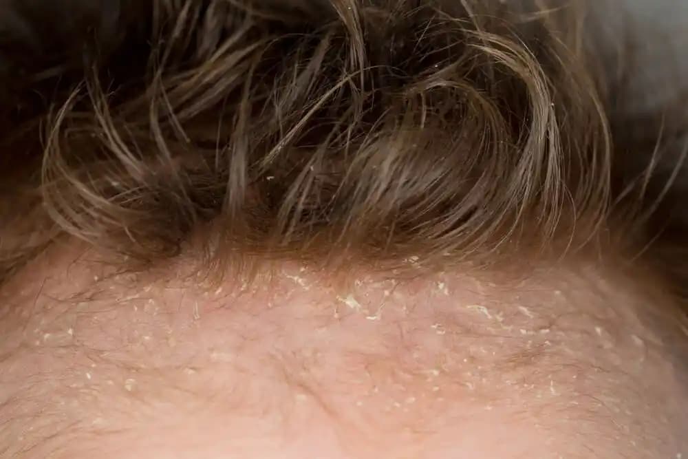 Yetişkinlerde Saçta Konak Nedir, Nedenleri ve Etkili Tedavi Yöntemleri