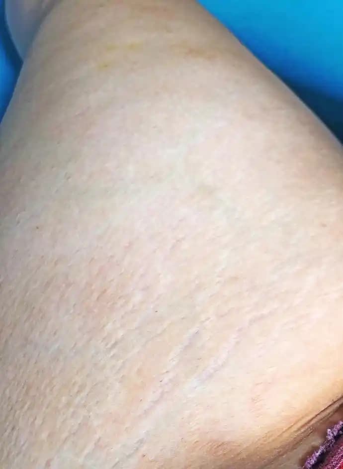 Yırtıkların Tedavisi ve Gelişmiş Çözüm Yöntemleriyle Cilt Sağlığını Koruma