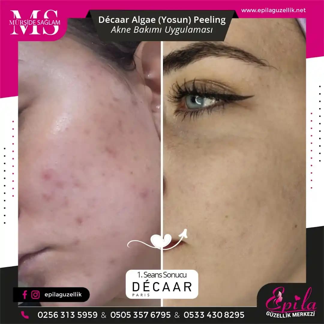 Yosun Peeling ile Doğal ve Sağlıklı Cilt Bakımı Yöntemleri Rehberi