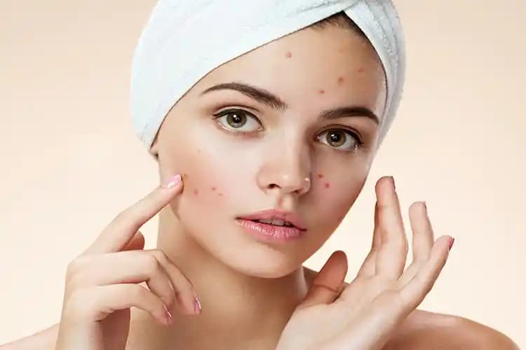 Yulaf ve Sivilce İlişkisi: Doğal Çözümler ile Cilt Sağlığını Destekleme Yolları