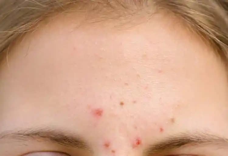 Yüz Kenarındaki Sivilceler ve Etkili Önleme Yöntemleri