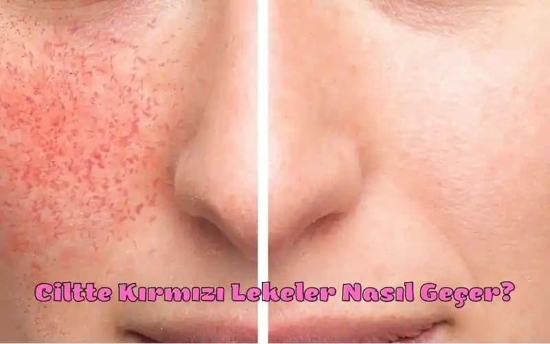 Yüzde Aniden Çıkan Kırmızı Lekelerin Nedenleri ve Etkili Tedavi Yöntemleri