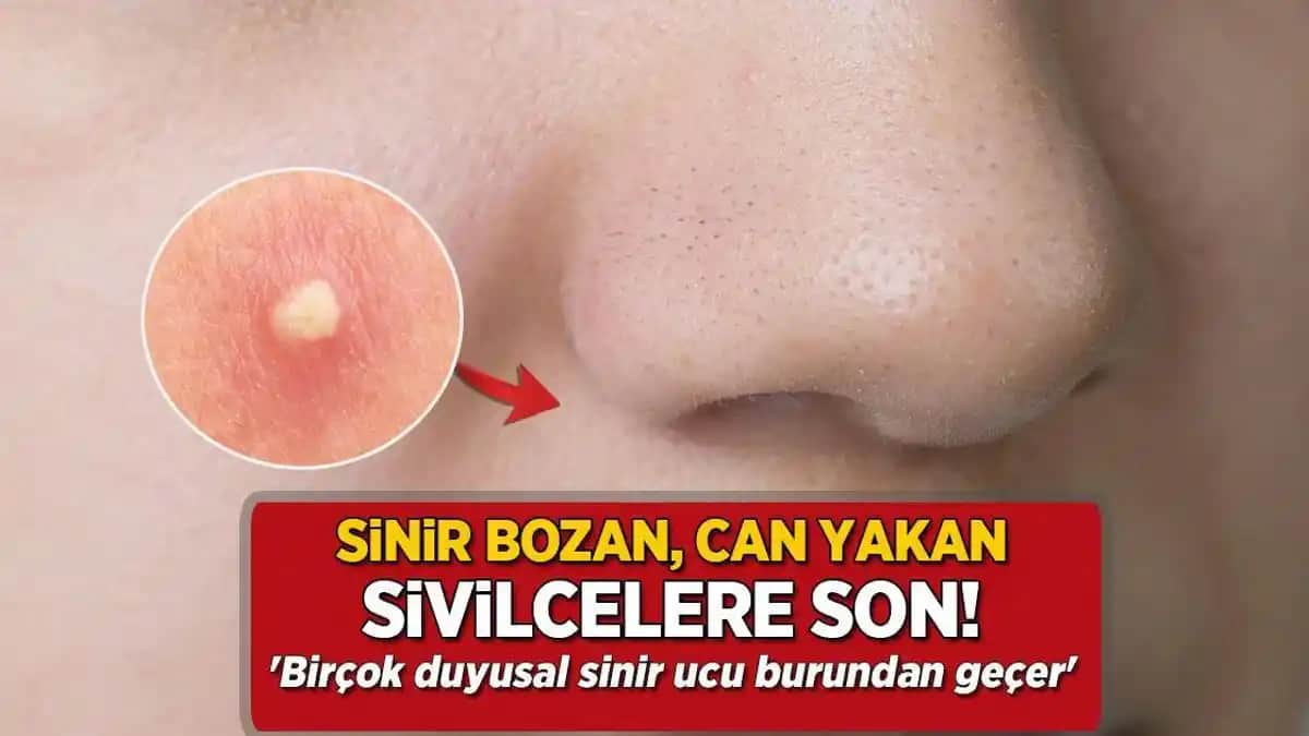 Yüzde Büyük Sivilceler: Nedenleri, Tedavi Yöntemleri ve Günlük Bakım İpuçları