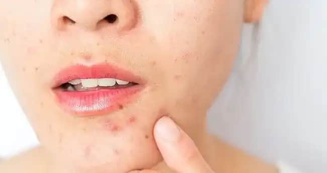 Yüzde Çıkan Sivilceler İçin Etkili Tedavi Yöntemleri ve Cilt Bakım İpuçları