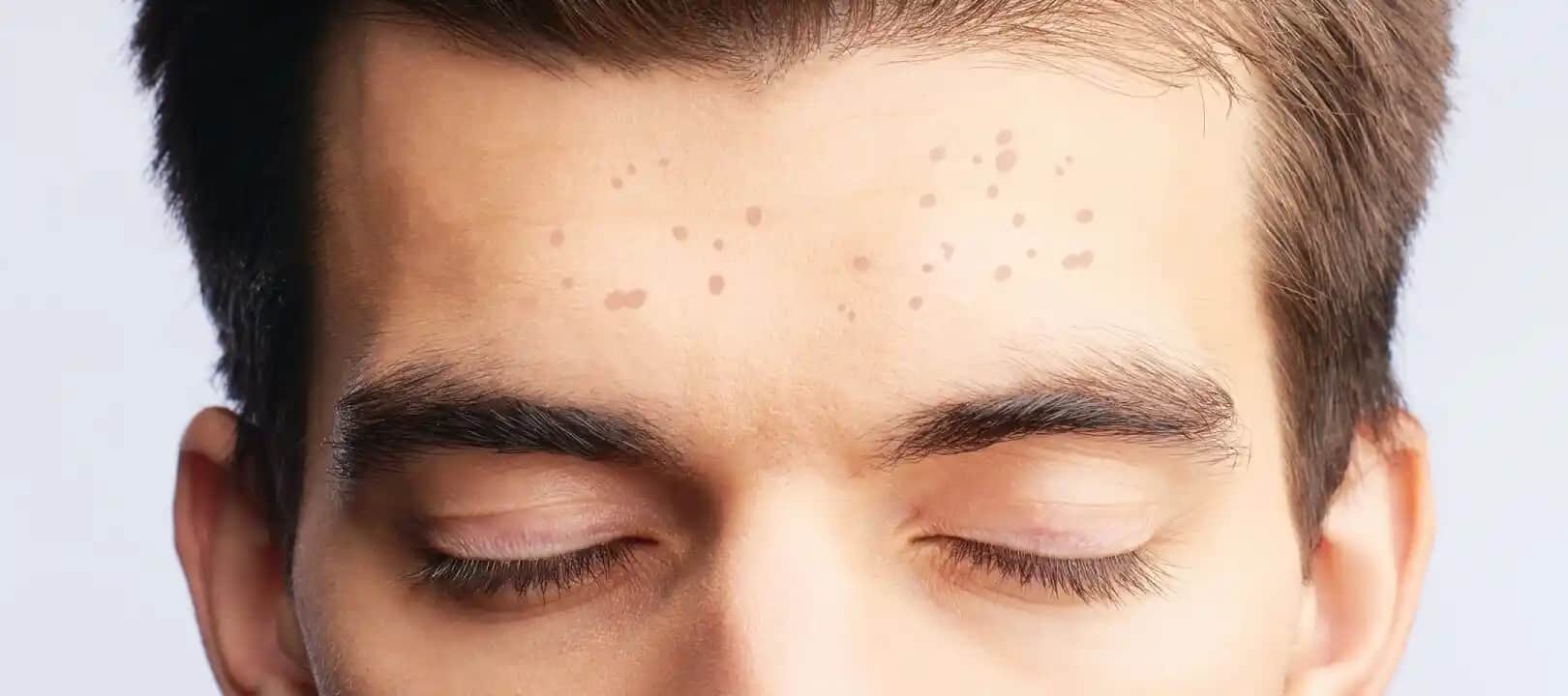 Yüzde Çil Nasıl Giderilir: Etkili Yöntemler ve Cilt Sağlığı İpuçları