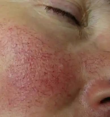 Yüzde Kılcal Damar Çatlaması Nedenleri ve Etkili Çözüm Yöntemleri