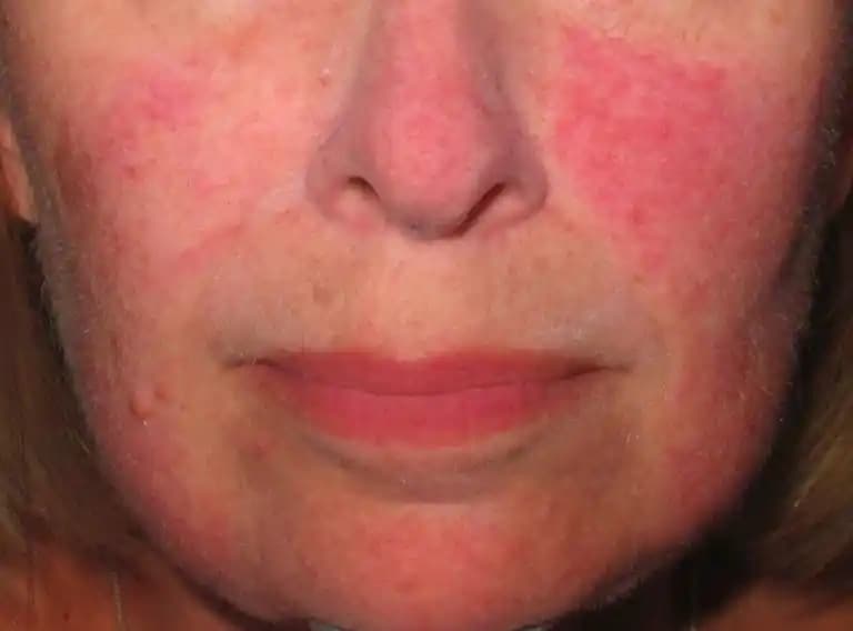 Yüzde Kırmızı Leke Nedenleri ve Kozmetik Tedavi Yöntemleri