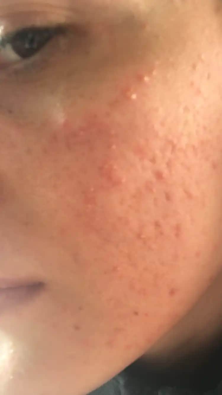 Yüzde Mantar ve Sivilce İlişkisi: Belirtiler, Nedenler ve Çözüm Yöntemleri