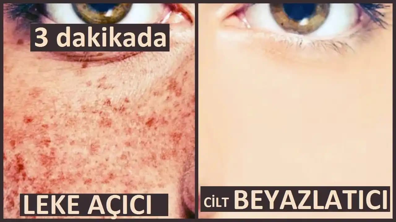 Yüzde Mor Leke Nedenleri, Çözüm Yolları ve Bakım İpuçları