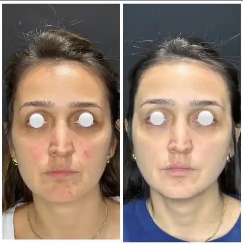 Yüzde Sivilce Benzeri Kabarıklıkların Nedenleri ve Doğal Çözüm Yolları