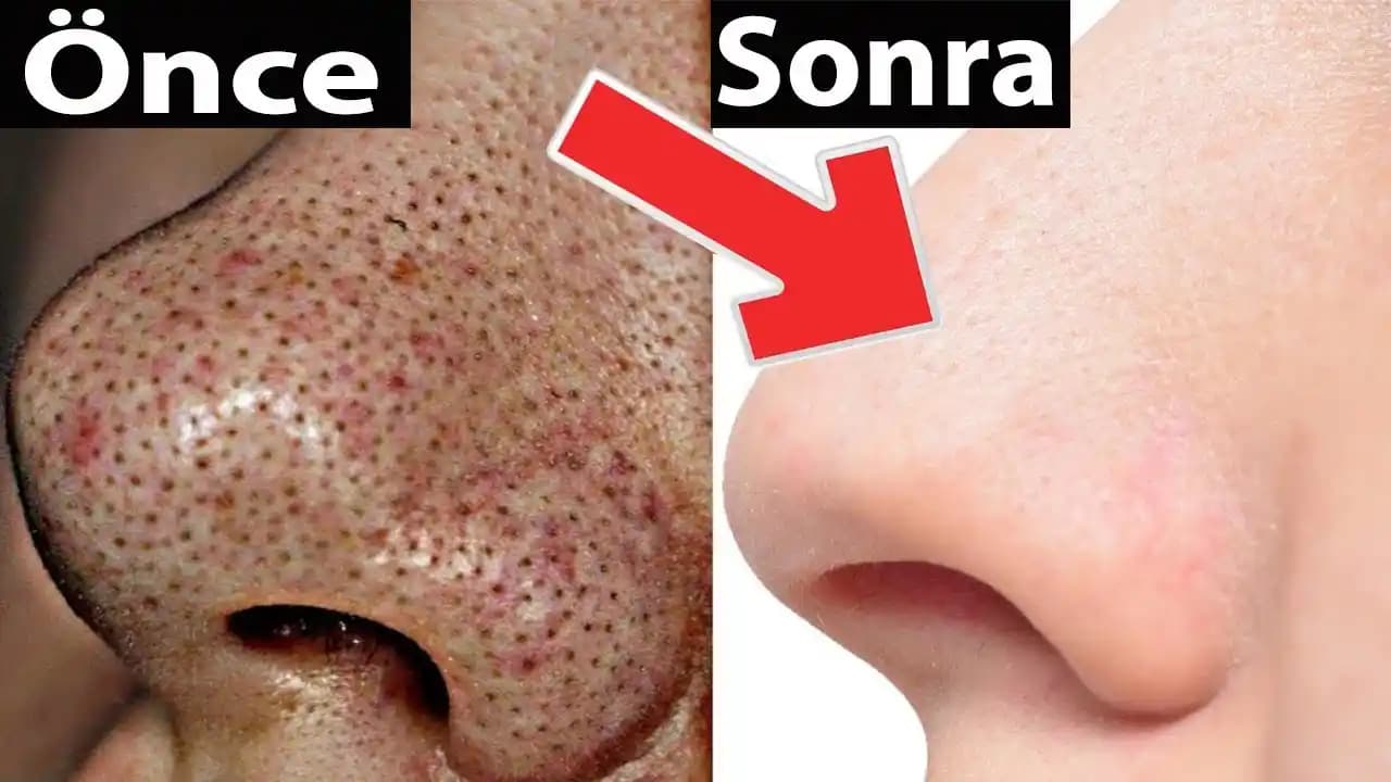 Yüzde Siyah Leke Nedenleri ve Etkili Kozmetik Çözüm Yöntemleri