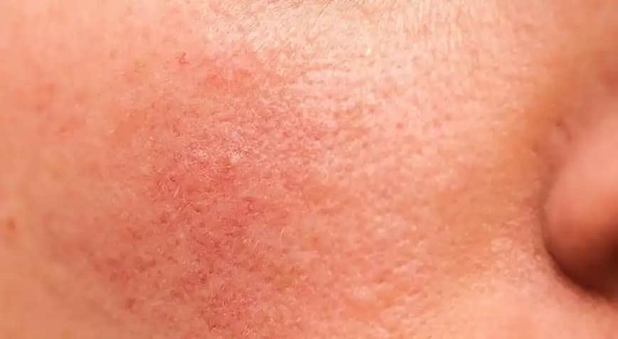 Yüzde Tokat Kızarıklığına Karşı Etkili Çözüm ve Bakım Yöntemleri