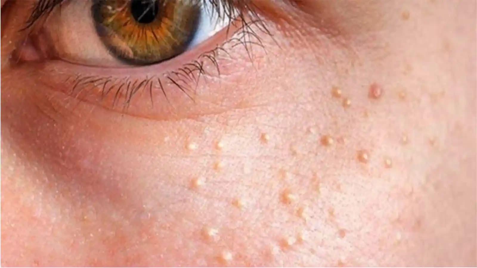 Yüzde Yağ Bezeleri Nedir ve Doğru Bakım ile Tedavi Yöntemleri