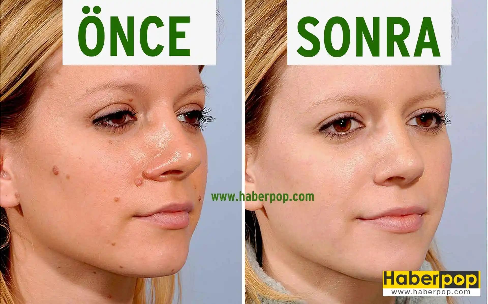 Yüzdeki Benler İçin Güvenilir ve Etkili Krem Kullanımı Rehberi