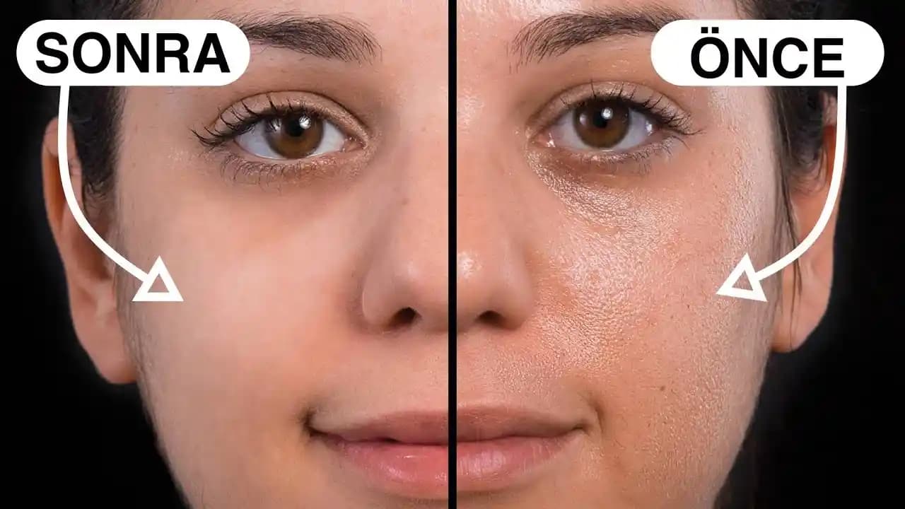 Yüzdeki Çukurların Oluşumu ve Etkili Güzellik Çözümleri İncelemesi