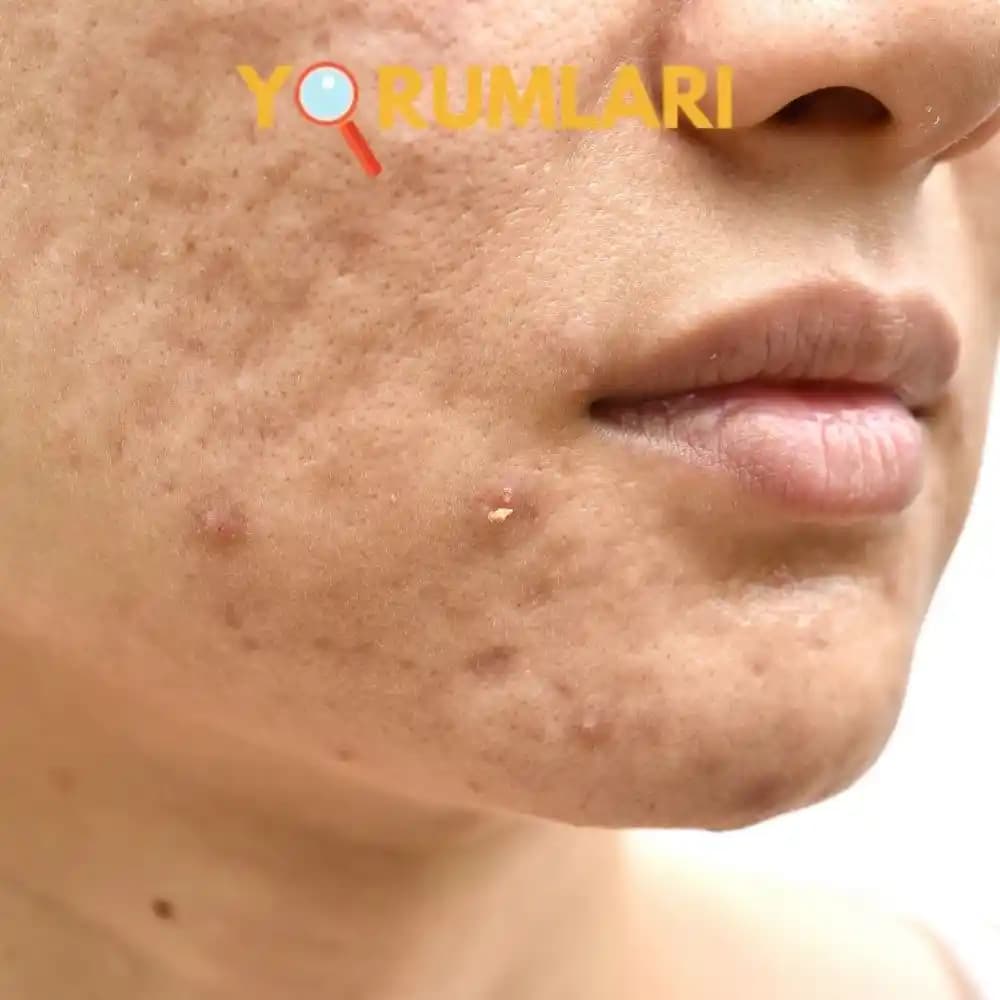 Yüzdeki Gözeneklerin Büyümesi Nedenleri ve Etkili Bakım Yöntemleri