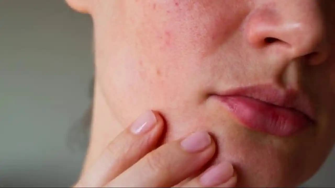 Yüzdeki Kabarcıkların Nedenleri ve Etkili Çözüm Yöntemleri