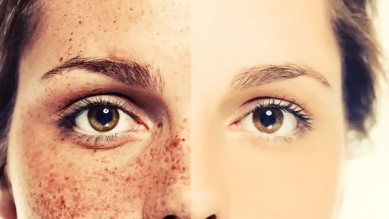 Yüzdeki Kahverengi Lekeleri Hafifletmek İçin Doğal ve Güvenli Çözüm Önerileri