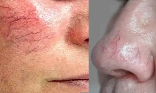 Yüzdeki Kılcal Damar Nedenleri ve Etkili Tedavi Yöntemleri Rehberi