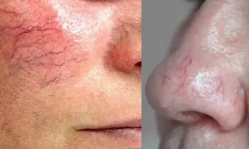 Yüzdeki Kılcal Damar Nedenleri ve Etkili Tedavi Yöntemleri Rehberi