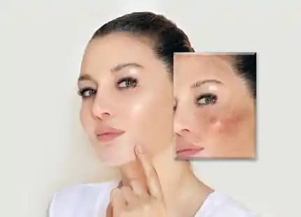 Yüzdeki Kırmızı Lekelerin Nedenleri ve Etkili Giderme Yöntemleri