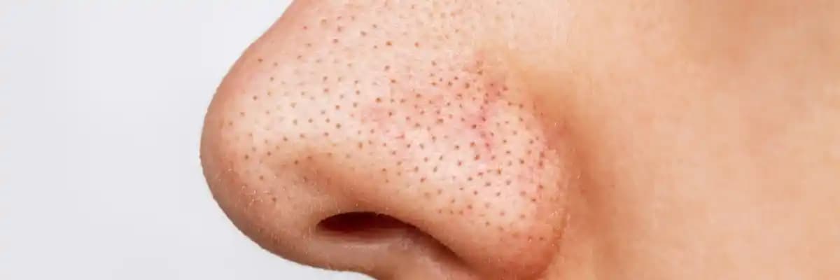 Yüzdeki Komedonların Nedenleri, Belirtileri ve Etkili Çözüm Yöntemleri Hakkında Detaylı Bilgi