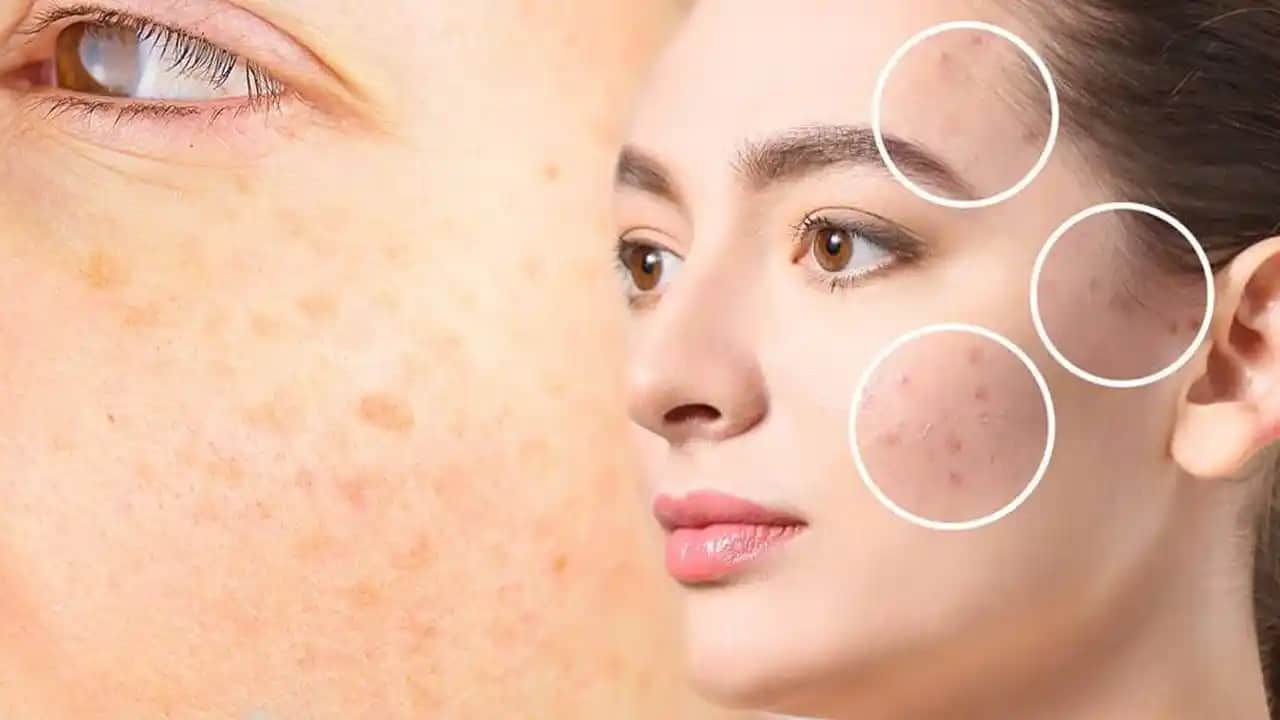 Yüzdeki Lekeleri Gidermek ve Cilt Tonunu Eşitlemek İçin Etkili Yöntemler ve İpuçları