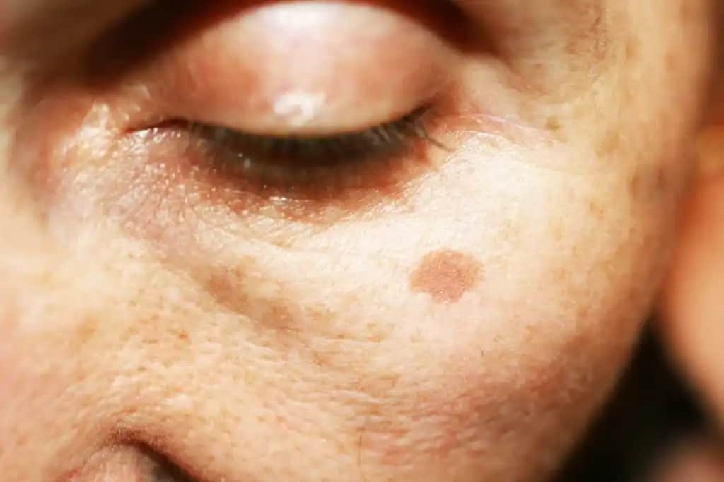 Yüzdeki Sarı Lekelerin Nedenleri ve Etkili Güzellik Çözüm Yöntemleri