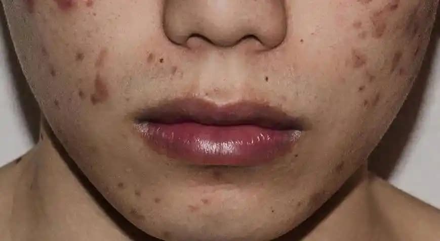 Yüzdeki Yara İyileşme Süreci ve Doğru Bakım Yöntemleri Hakkında Bilgiler