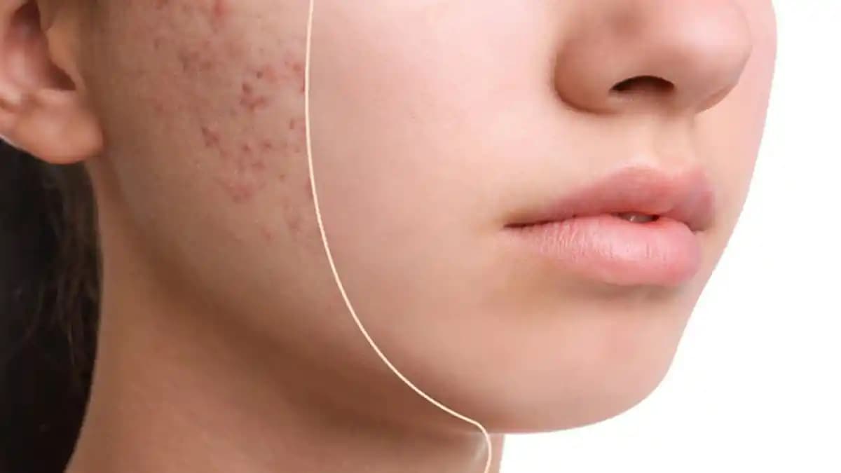 Yüzdeki Yara Lekeleri Nasıl Giderilir: Etkili Çözüm ve Tedavi Yöntemleri