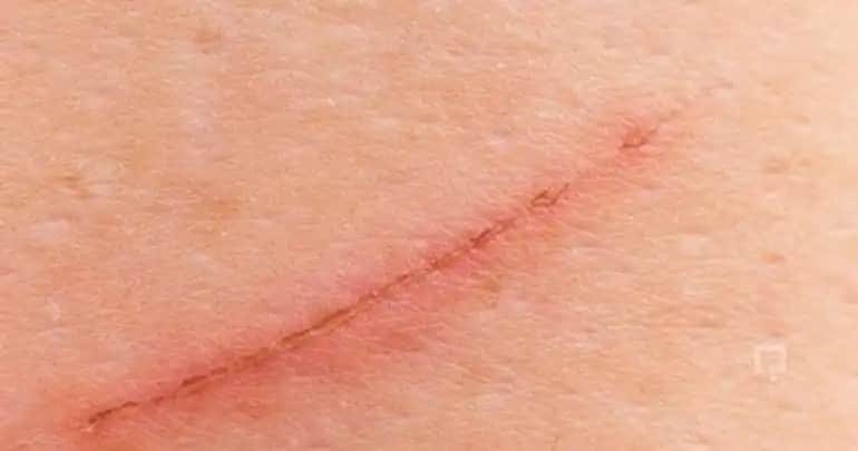 Yüzeysel Tırnak İzi Nedir ve Sağlıklı Tırnaklar İçin Alınabilecek Önlemler