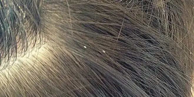 Kafada Bit Belirtileri ve Gözlemlenebilir İşaretler: Erken Tanı ve Önlemler