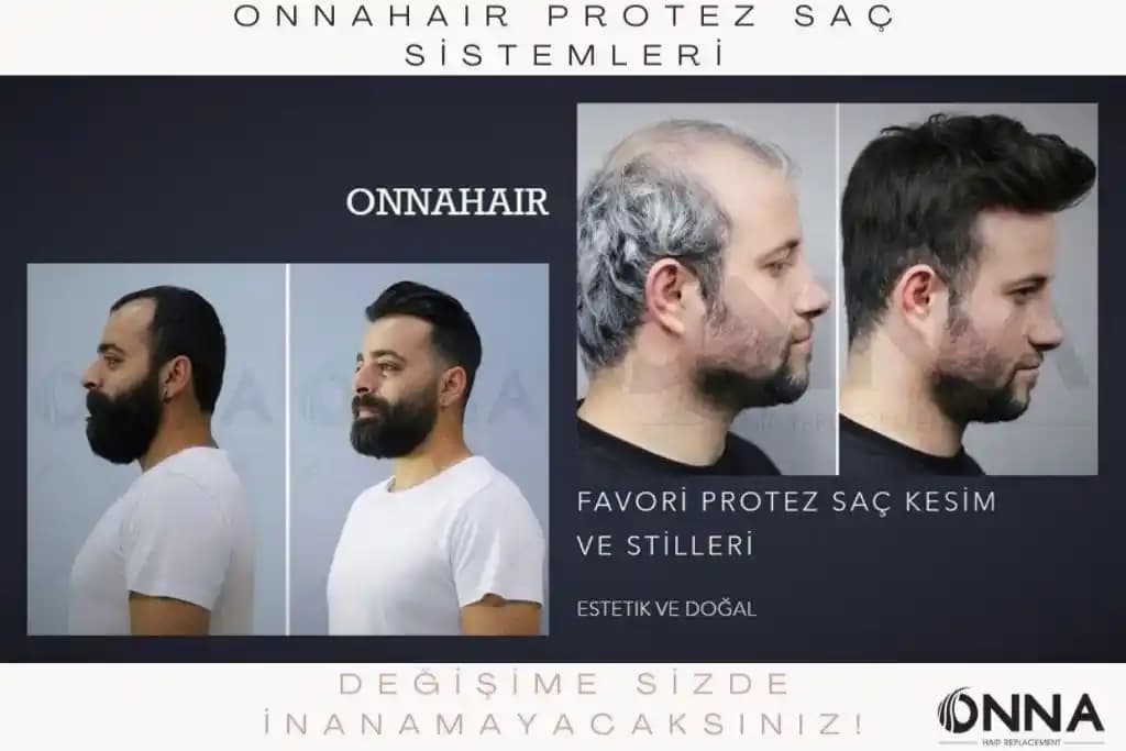 Protez Saç Çeşitleri ve Teknik Özellikleri ile Saç Dökülmesine Estetik Çözümler