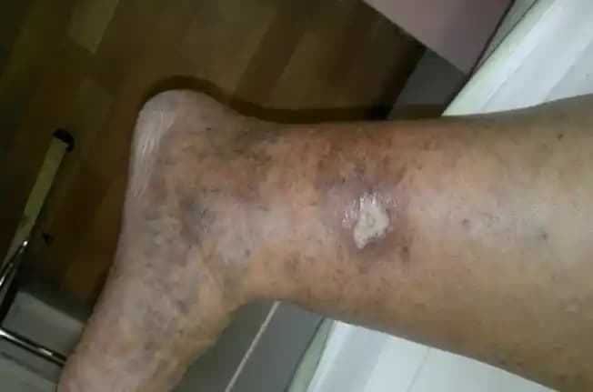 Ayak Lekeleri ve Çözüm Yolları: Sağlıklı ve Pürüzsüz Ayaklar İçin Bilmeniz Gerekenler